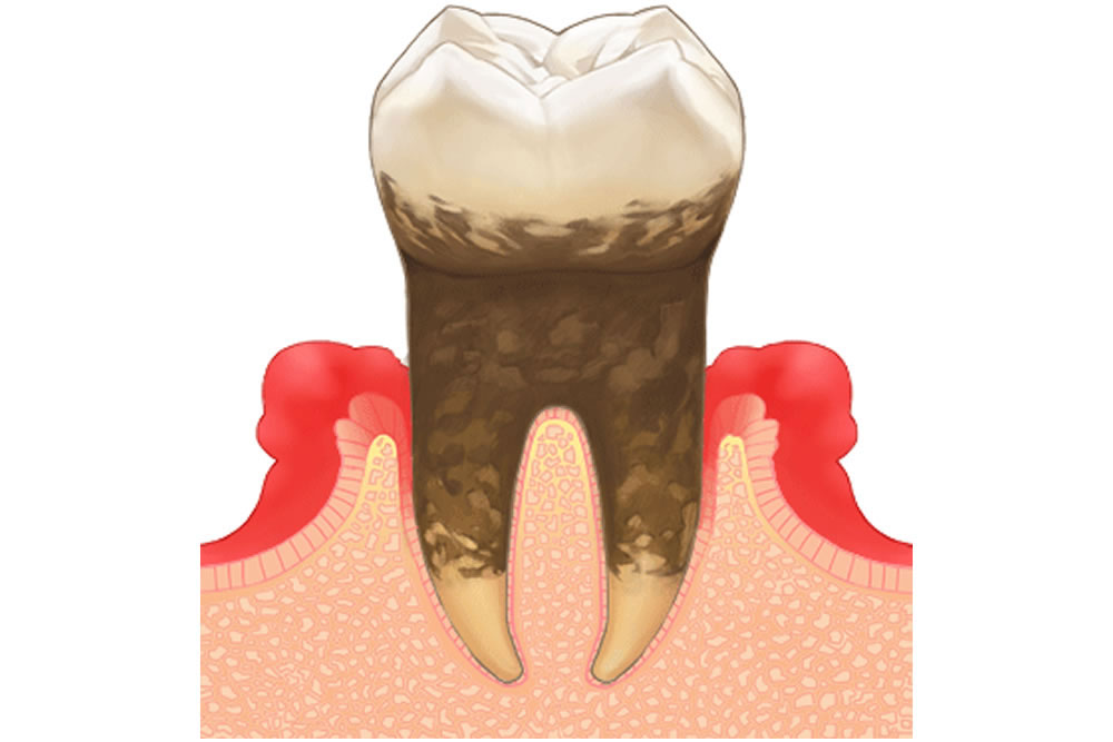 歯周病治療